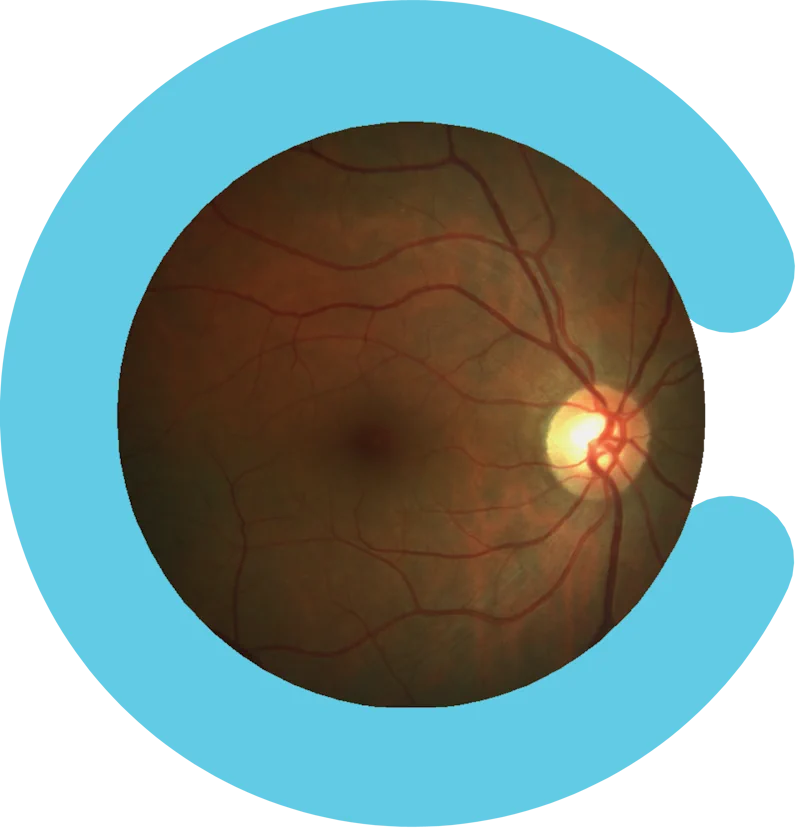 fotocolor ocular